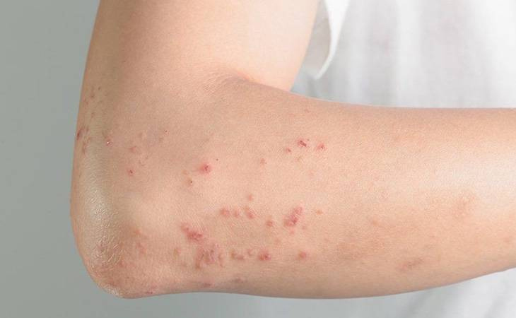 Viêm da cơ địa vị trí khuỷu tay