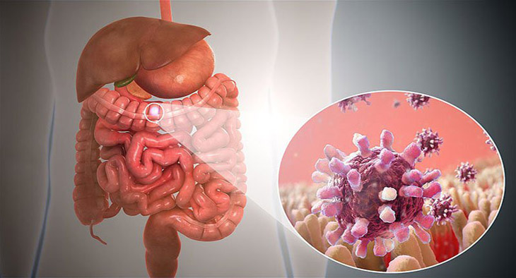 Viêm dạ dày ruột cấp là tình trạng đường tiêu hóa bị tấn công