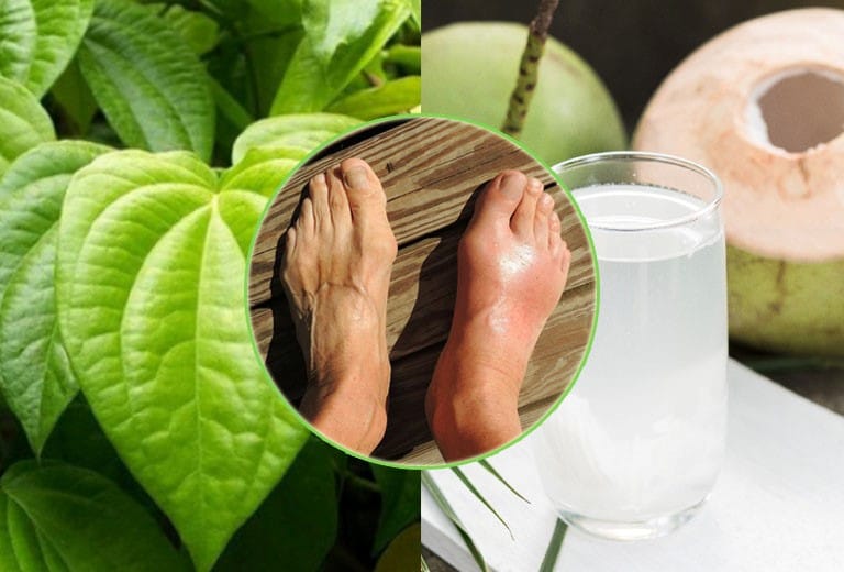 Mẹo chữa gout tại nhà chỉ giúp kiểm soát triệu chứng bên ngoài, dễ tái phát lại