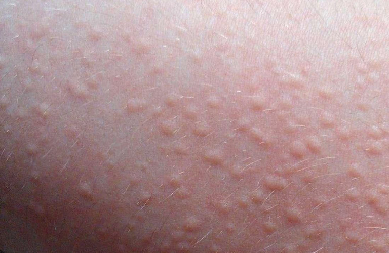 Mề đay là bệnh lý tự miễn khá phổ biến