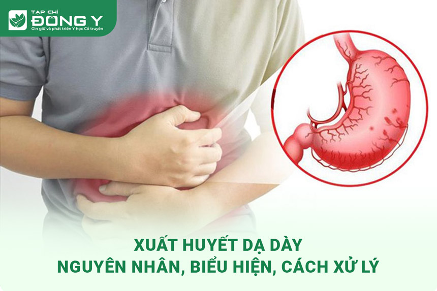 xuat-huyet-da-day