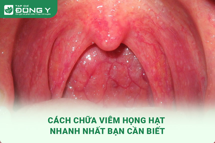 cach-chua-viem-hong-hat-nhanh-nhat