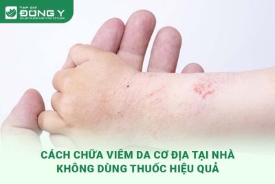 chua-viem-da-co-dia