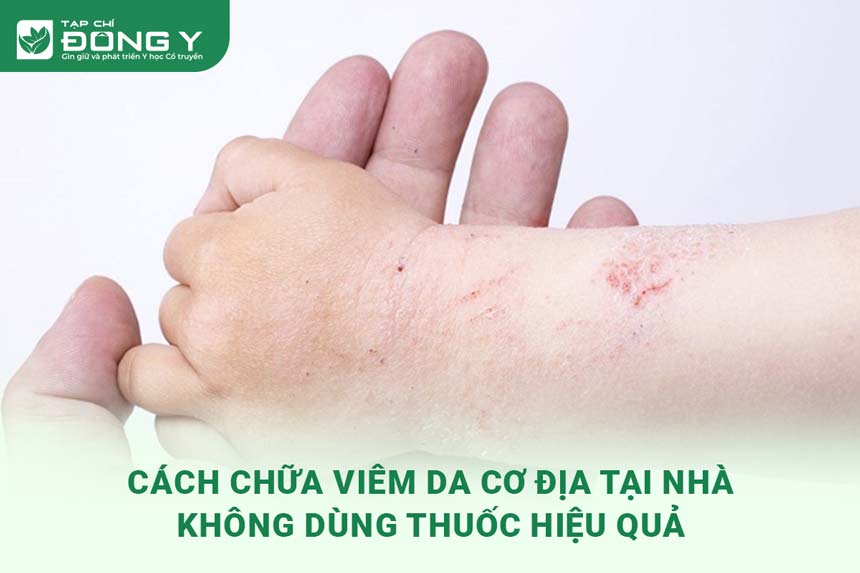 chua-viem-da-co-dia