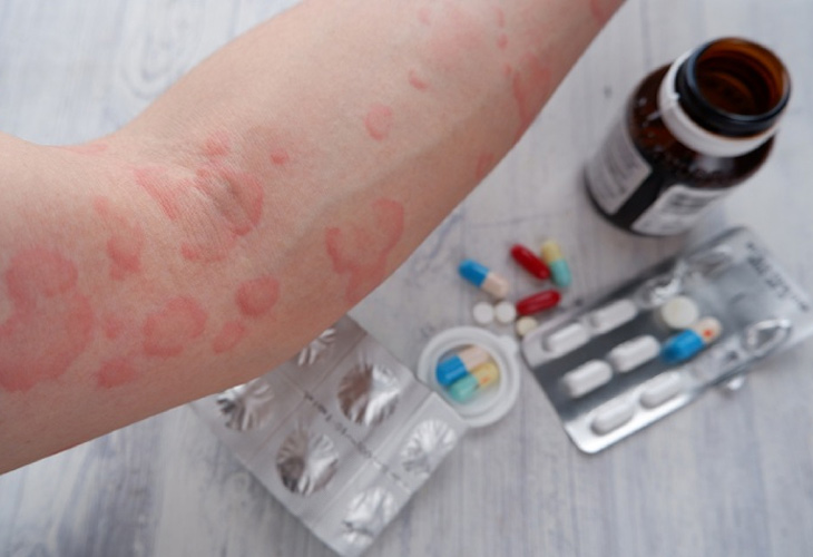 Cần cân nhắc nhiều yếu tố trước khi lựa chọn thuốc trị mề đay