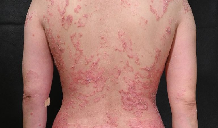 Người bệnh vảy nến cần chú ý đến thực đơn ăn uống hàng ngày để điều trị bệnh