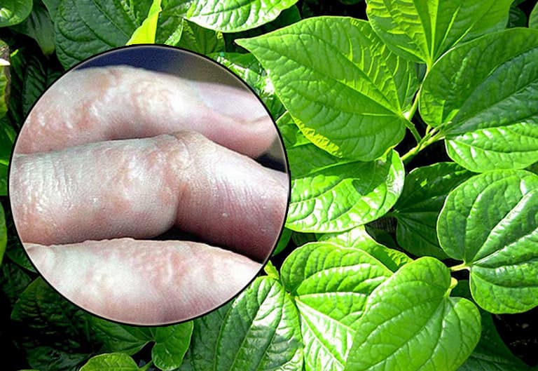 Sử dụng lá trầu để chữa bệnh tổ đỉa ở trẻ là mẹo dân gian được nhiều người dùng