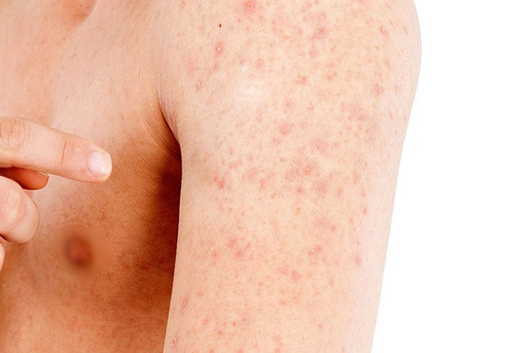 Có nhiều nguyên nhân gây nổi mẩn đỏ không ngứa