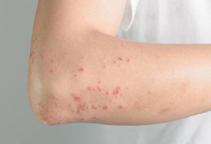 Mẩn đỏ không ngứa ở tay có thể do giãn mao mạch