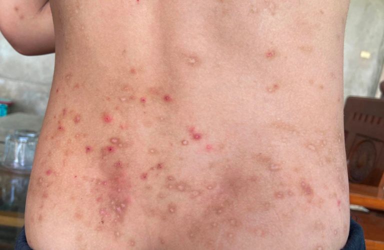 Dị ứng da trong thời gian dài gây ngứa diện rộng cần đi khám bác sĩ