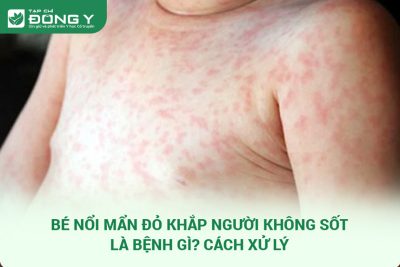 Bé Nổi Mẩn Đỏ Khắp Người Không Sốt