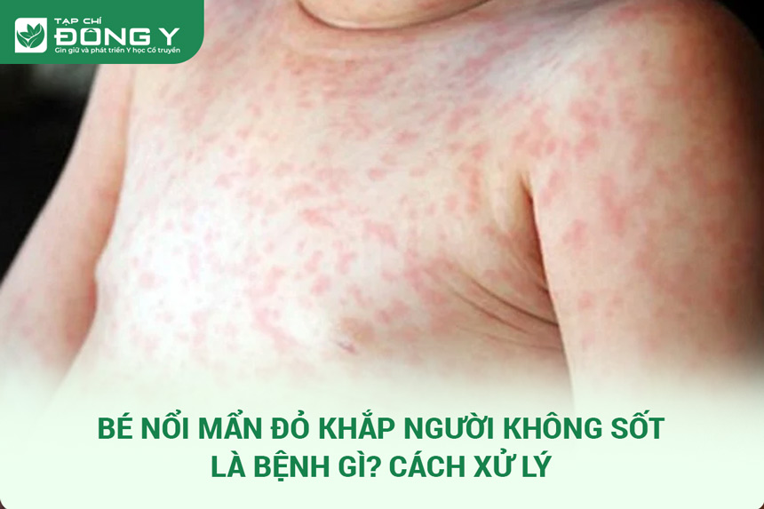 Bé Nổi Mẩn Đỏ Khắp Người Không Sốt