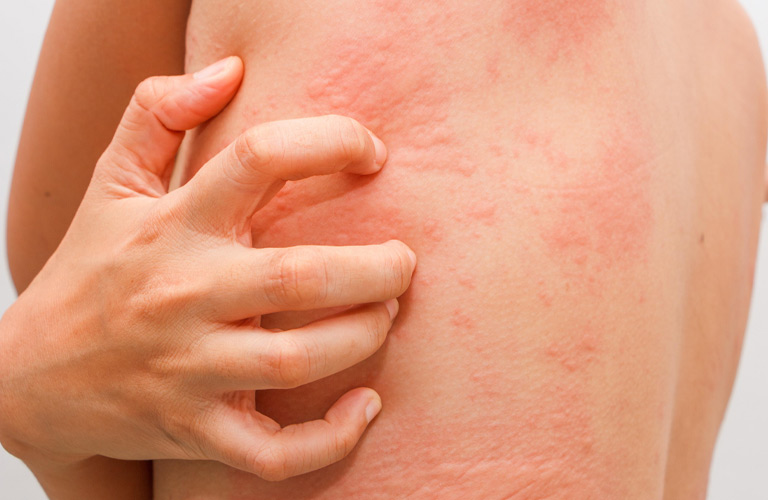 Ngứa nổi mẩn đỏ là tình trạng da phản ứng với tác nhân gây hại