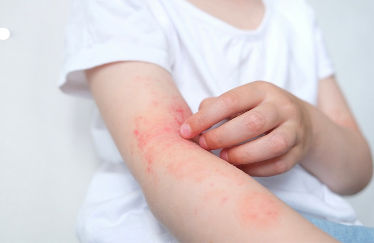 Mẩn ngứa có hiện tượng lan rộng cần đến gặp bác sĩ để thăm khám