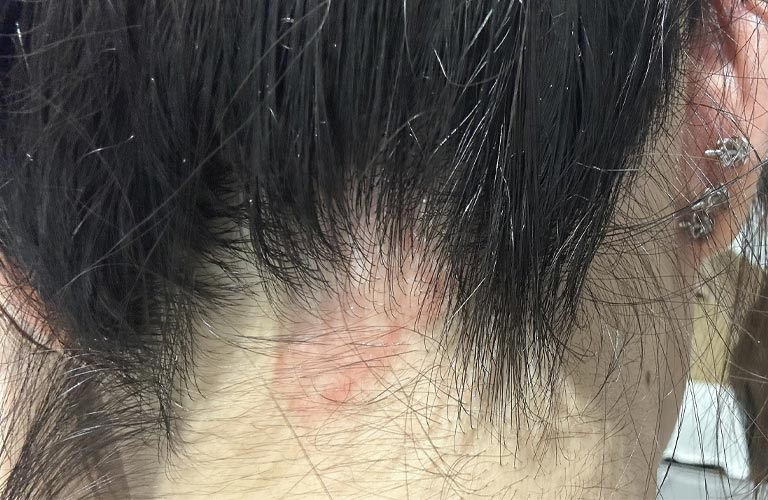Dị ứng cũng là nguyên nhân bị ngứa da đầu và rụng tóc