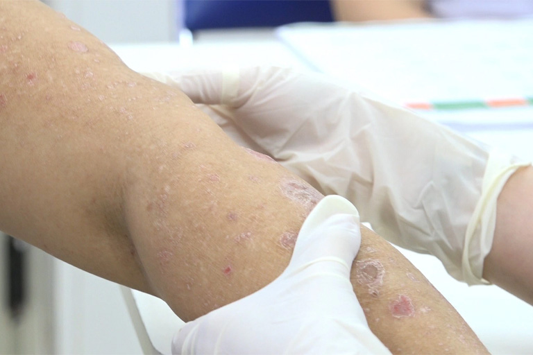 Bác sĩ dựa vào triệu chứng bệnh để đưa ra đánh giá ban đầu