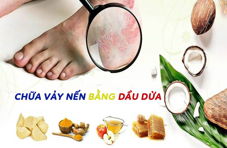 Dầu dừa giúp tiêu diệt nấm, vi khuẩn và virus gây bệnh trên da