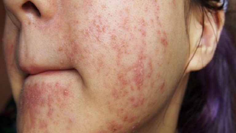 Da bị nhiễm corticoid thường có biểu hiện đỏ, bong tróc, nổi mụn