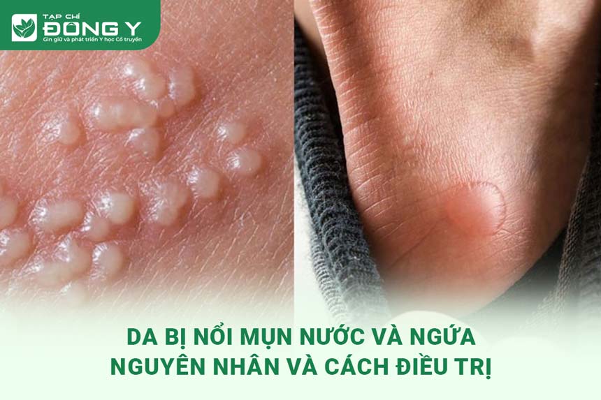 da-bi-noi-mun-nuoc-va-ngua