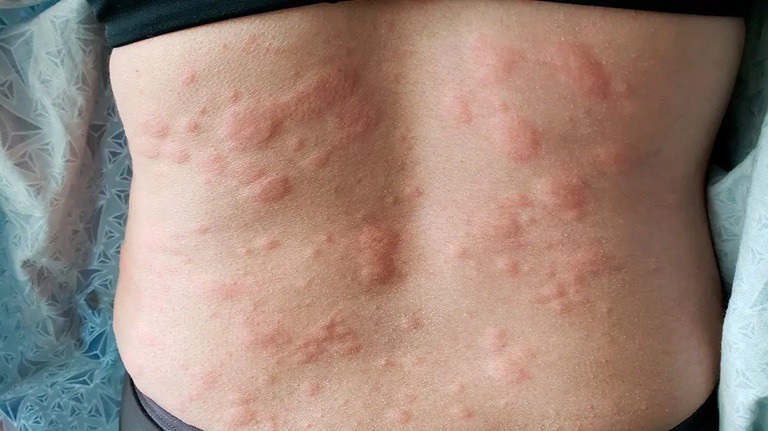 Nổi mề đay khi trời lạnh là tình trạng da xuất hiện các sẩn phù, mẩn đỏ
