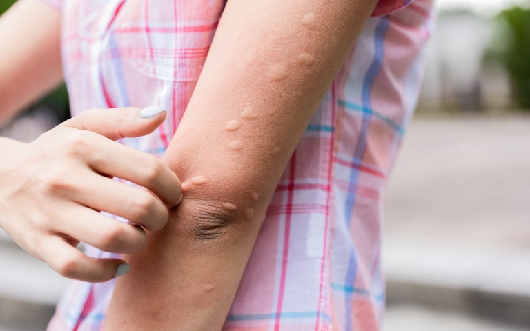 Thời tiết thay đổi đột ngột là nguyên nhân chính dẫn đến nổi mề đay