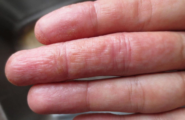 Tay bị ngứa nổi mụn nước kèm triệu chứng ngứa ngáy hoặc đau rát khó chịu