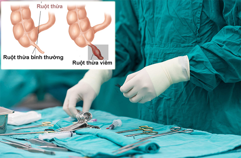 Mổ ruột thừa ở đâu tốt? Chi phí cho một lần mổ là bao nhiêu tiền?