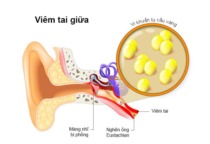 Viêm tai giữa biến chứng có thể gây viêm mê nhĩ