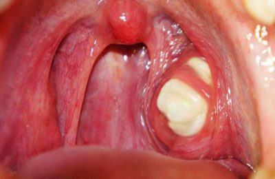 Viêm họng ho có đờm gây nhiều khó chịu cho người bệnh