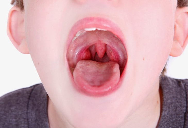 Trẻ nhỏ với hệ miễn dịch yếu có nguy cơ mắc bệnh cao hơn