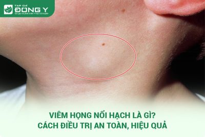 viêm họng nổi hạch