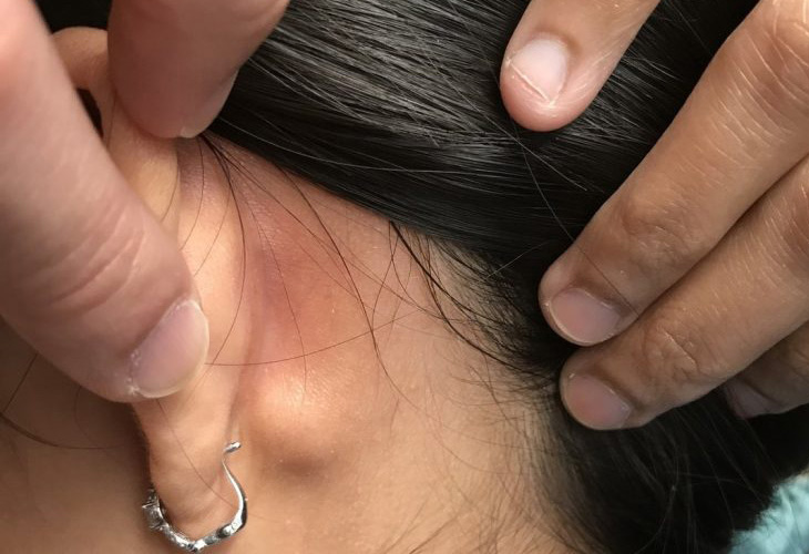 Hạch có thể nổi sau tai người bệnh viêm họng