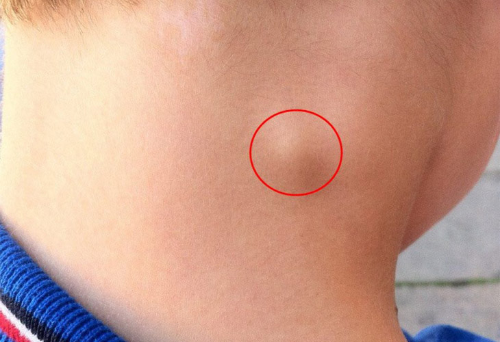 Viêm họng nổi hạch là tình trạng viêm đau họng kèm theo nổi hạch