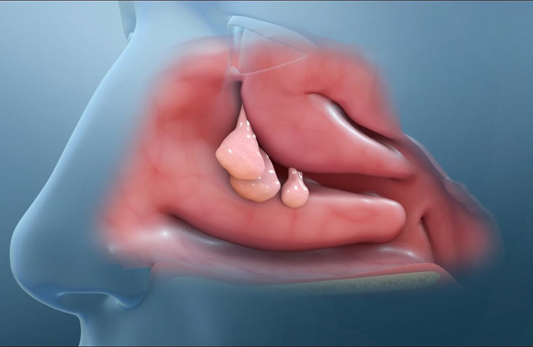 Polyp mũi là một biến chứng điển hình của viêm mũi dị ứng