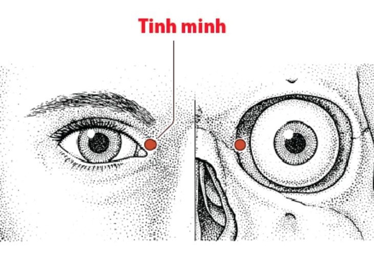 Huyệt Tình minh có tác dụng thông mũi, giảm chảy nước mắt