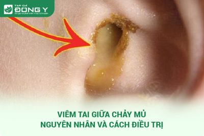 Viêm tai giữa chảy mủ