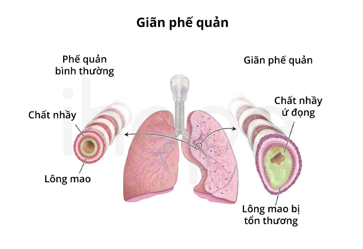 Giãn phế quản có thể là nguyên nhân gây đau họng xuất huyết